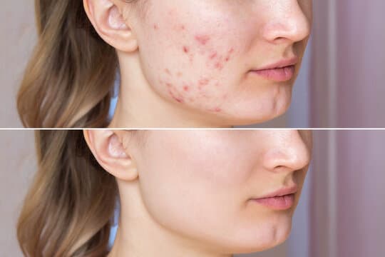 Acne & Acne Scars