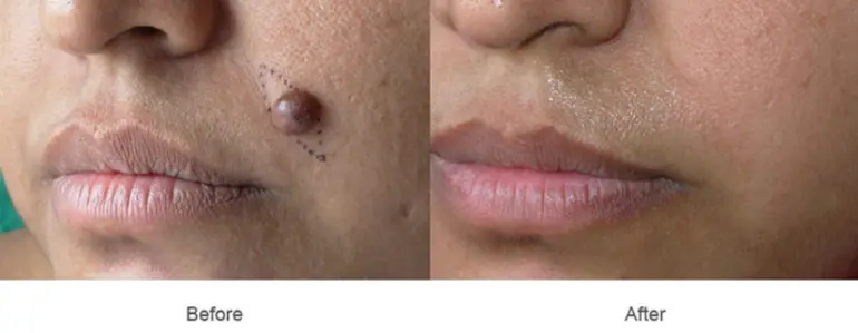 Mole Removal