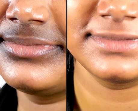 Peri-oral Pigmentation (Pigmentation Around the Mouth)