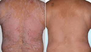 Psoriasis