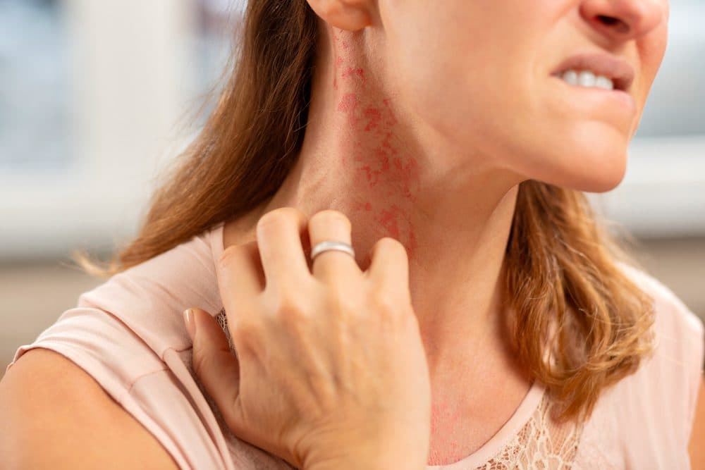 Skin Allergy & Rashes