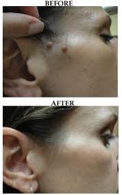Skin Tag Removal