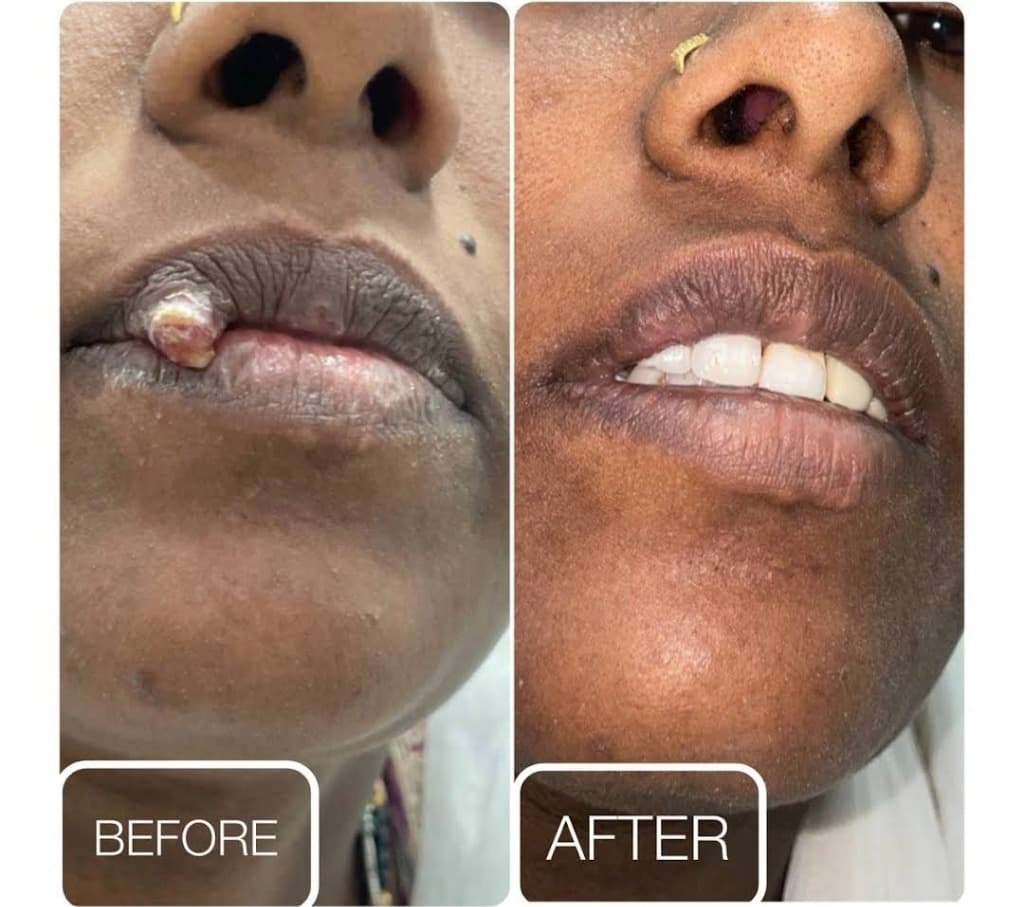 Treatment Result